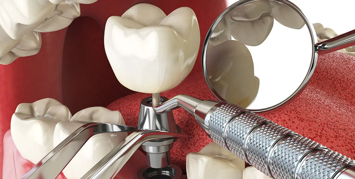 Dental implants made of Ti6Al4V alloy