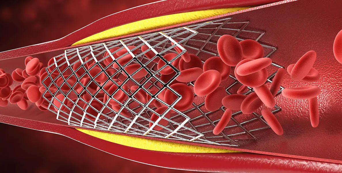 cardiac stent